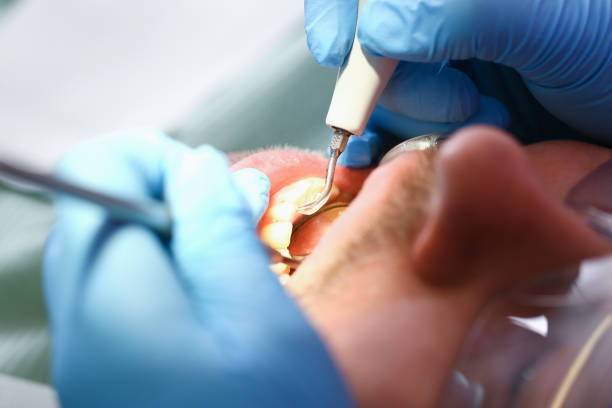 Best Emergency Dentist for Lost Fillings or Crowns in Springfield, GA