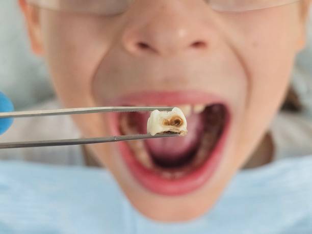 Best Broken or Cracked Tooth Emergency Dentist in Springfield, GA